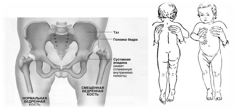 Схема врожденного вывиха бедра