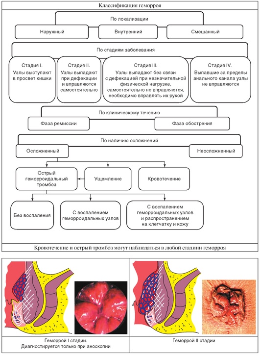 Геморроидальное кровотечение карта смп - 87 фото
