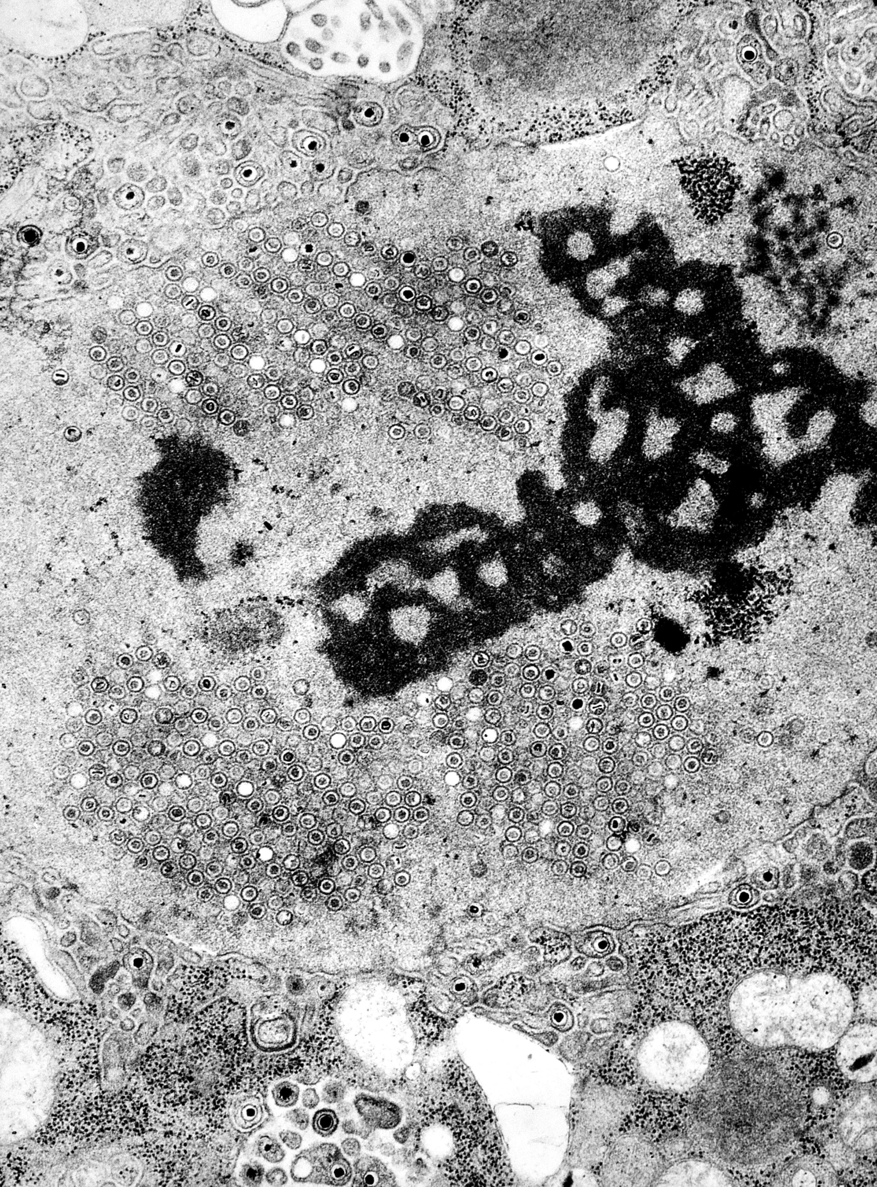 Herpes simplex virus i ii