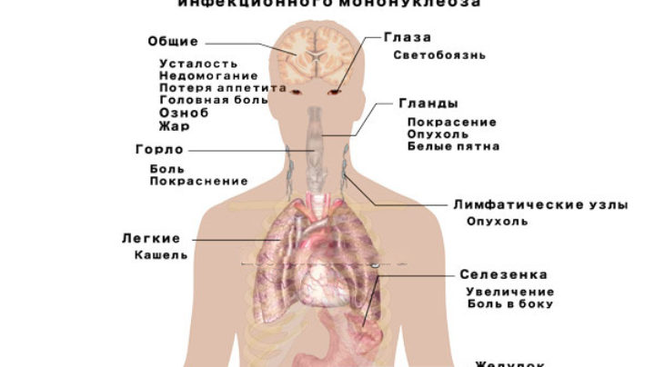 Инфекционный мононуклеоз. Инфекционный мононуклеоз симптомы. Вирусный мононуклеоз симптомы. Мононуклеоз проявления болезни. Симптомы инфекционного мононуклеоза симптомы.