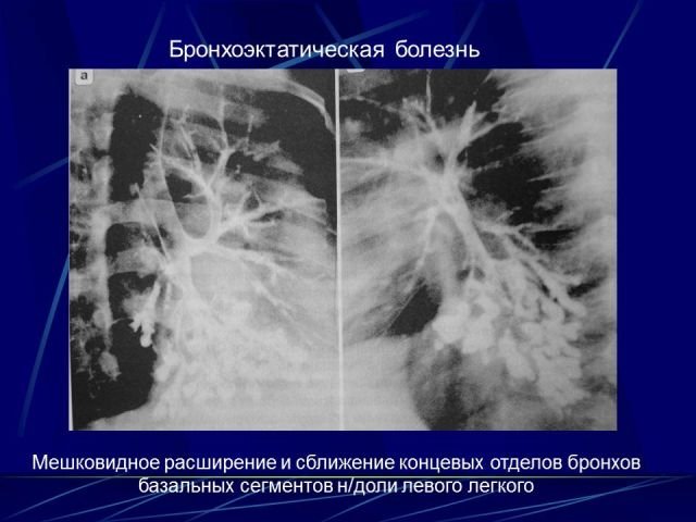 Рентген картина бронхоэктазов