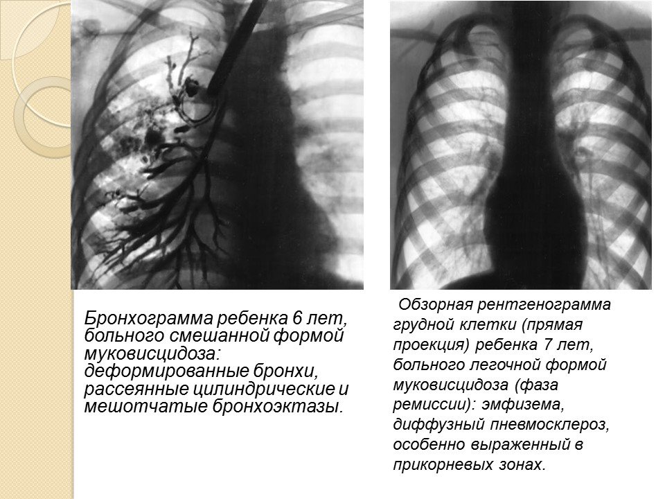 Кистозный фиброз презентация