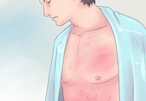 у мужчины на коже сыпь — рисунок