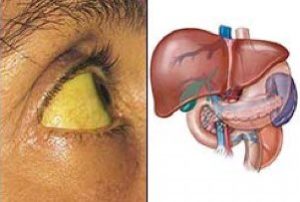 больная печень человека и жёлтые склеры глаз