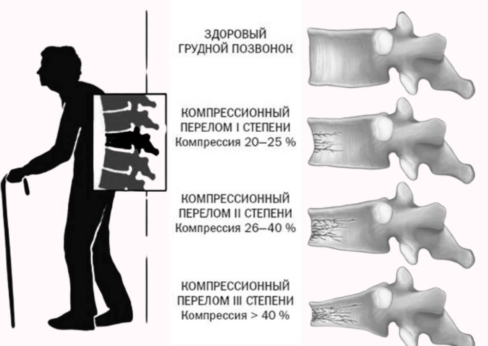 Лечение последствия компрессионного перелома позвоночника