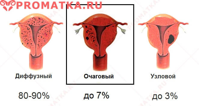 Формы аденомиоза - схема