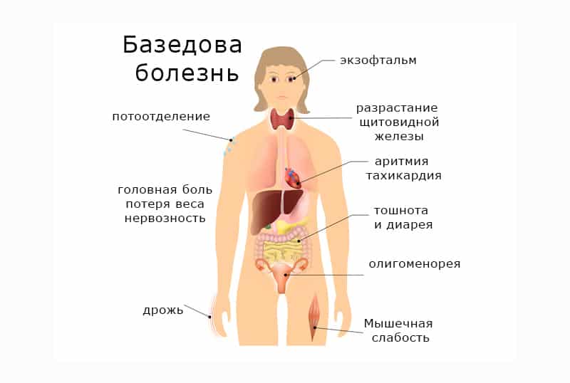 Признаки желез. Клинические симптомы базедовой болезни. Характерный признак базедовой болезни. Базедова болезнь щитовидки. Базедова болезнь патогенез проявления.