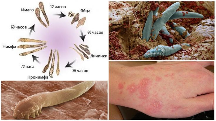 Лечение демодекоза у человека