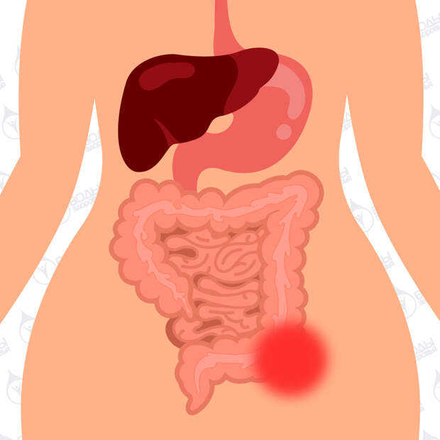 Кишечные колики у взрослых. Метеоризм кишечника и колики. Спазм кишечника от нервов. Как проявляются спазмы кишечника у женщин.