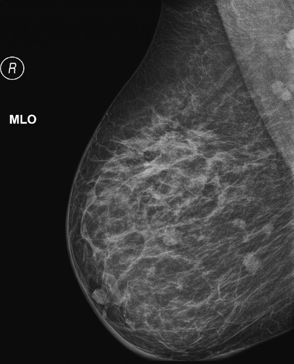доброкачественные опухоли в груди у женщин фото 73