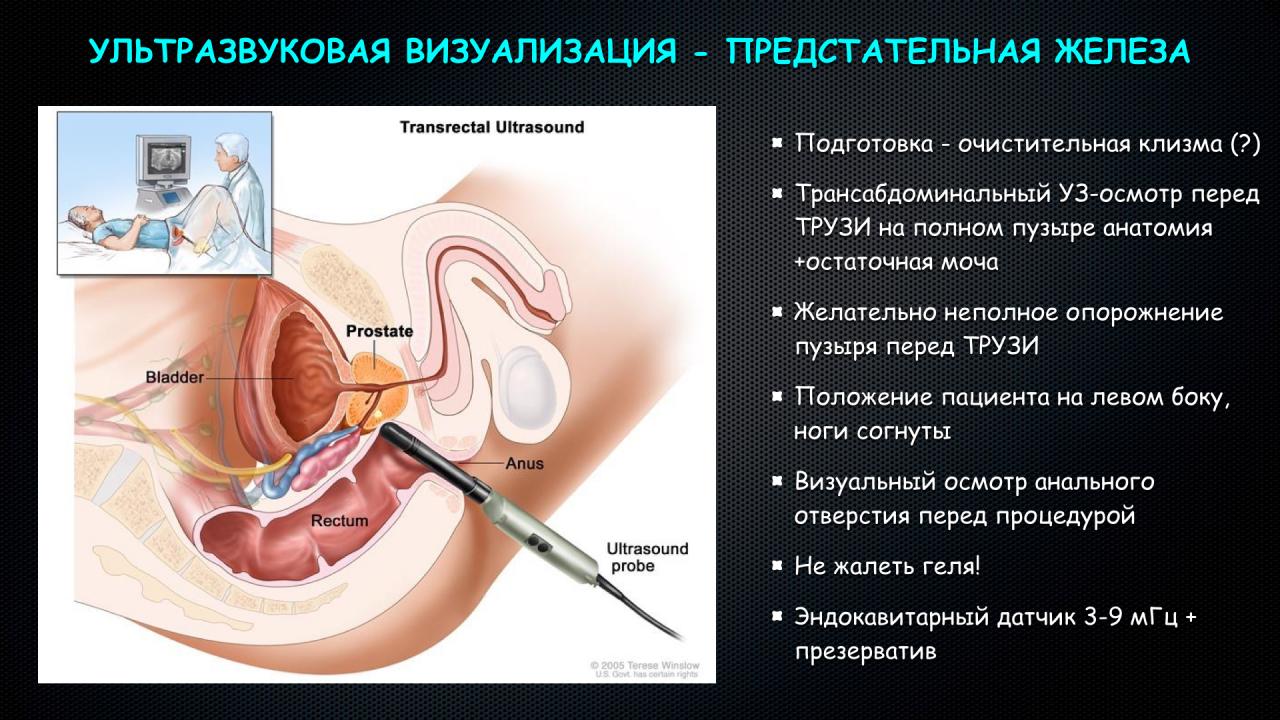 Как делают узи предстательная железа у мужчин в картинках