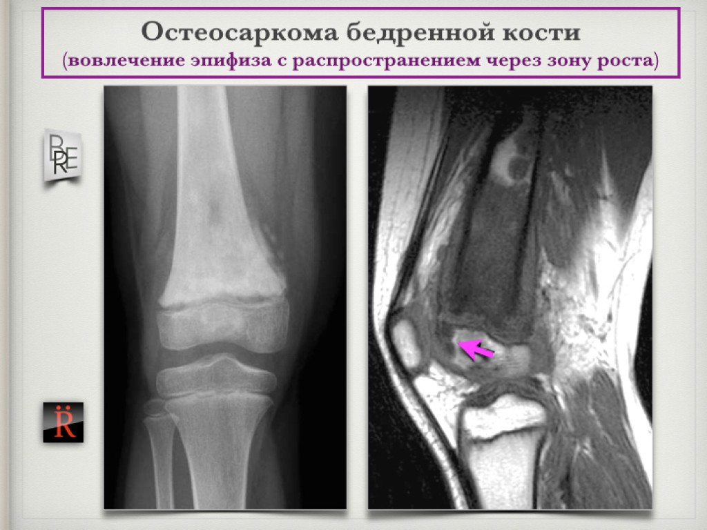 Остеосаркома. Кт остеосаркома большеберцовой кости. Костные опухоли эпифиза бедренной кости. Эпифиз большеберцовой кости рентген кисты. Киста эпифиза бедренной кости.