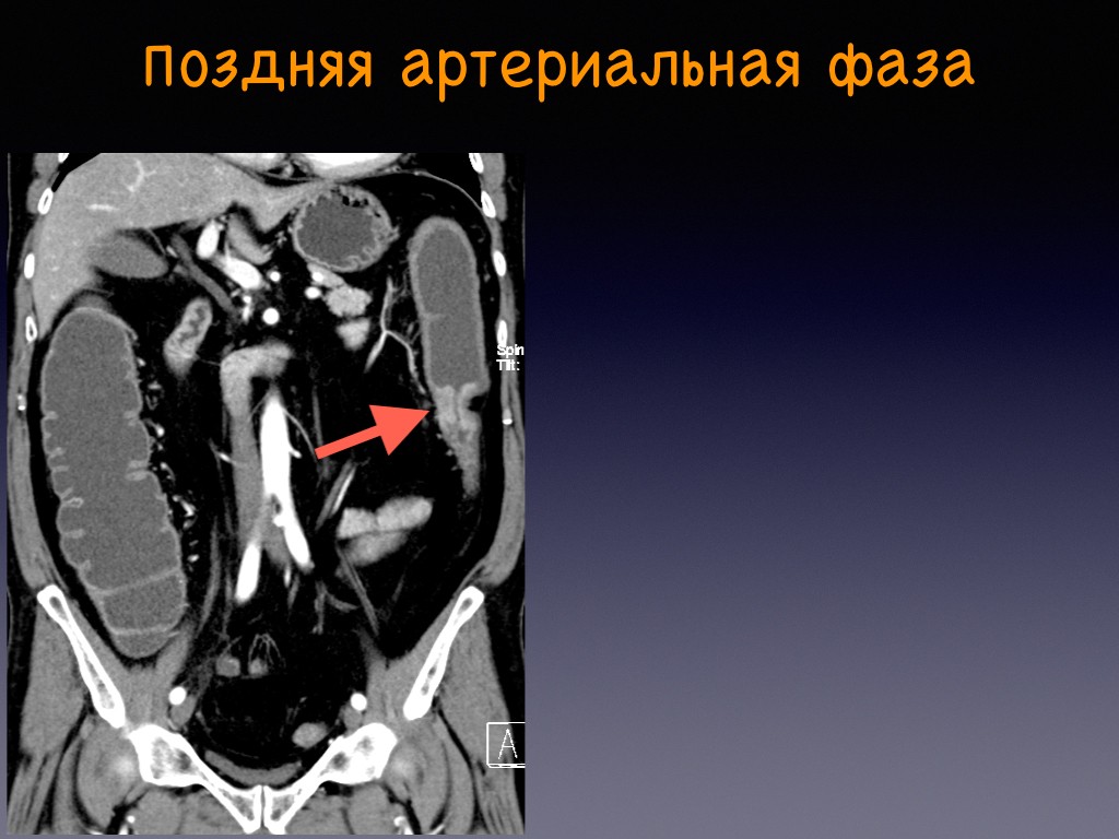 Что показывает кт брюшной. Контрастирование при кт брюшной полости. Кт брюшной полости артериальная фаза. Фазы контрастирования брюшной полости кт. Мультиспиральная кт брюшной полости.