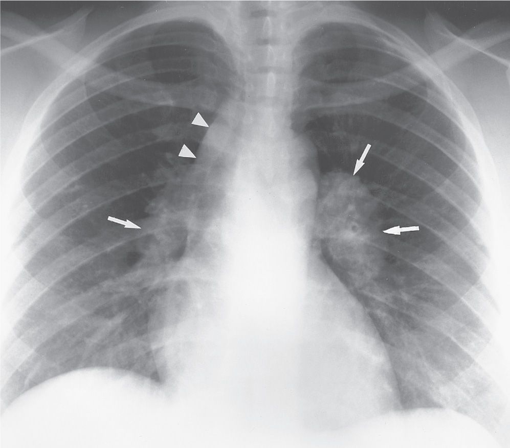 К т легких 10. Саркоидоз 1 стадия рентген. Саркоидоз рентгенологическая картина. Саркоидоз внутригрудных лимфоузлов рентген.