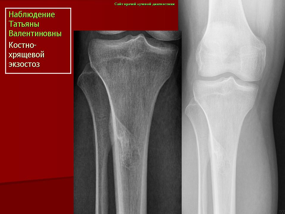Экзостоз кости. Костно-хрящевой экзостоз. Остеохондрома коленного сустава рентген. Экзостоз большеберцовой кости рентген.