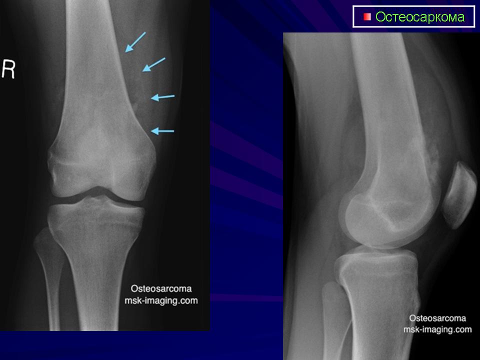 Саркомы костей нмо. Остеосаркома коленного сустава рентген. Саркома коленного сустава рентген.