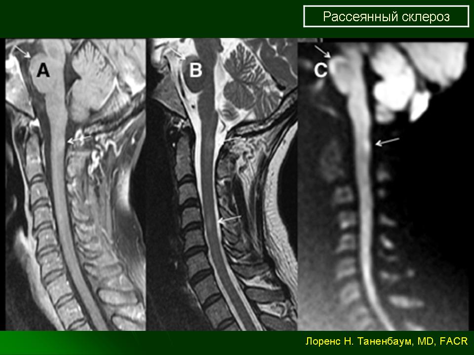 Как распознать склероз. Рассеянный склероз. Рассеянный склероз фото. Рассеянный склероз на снимках. Рассеянный множественный склероз.