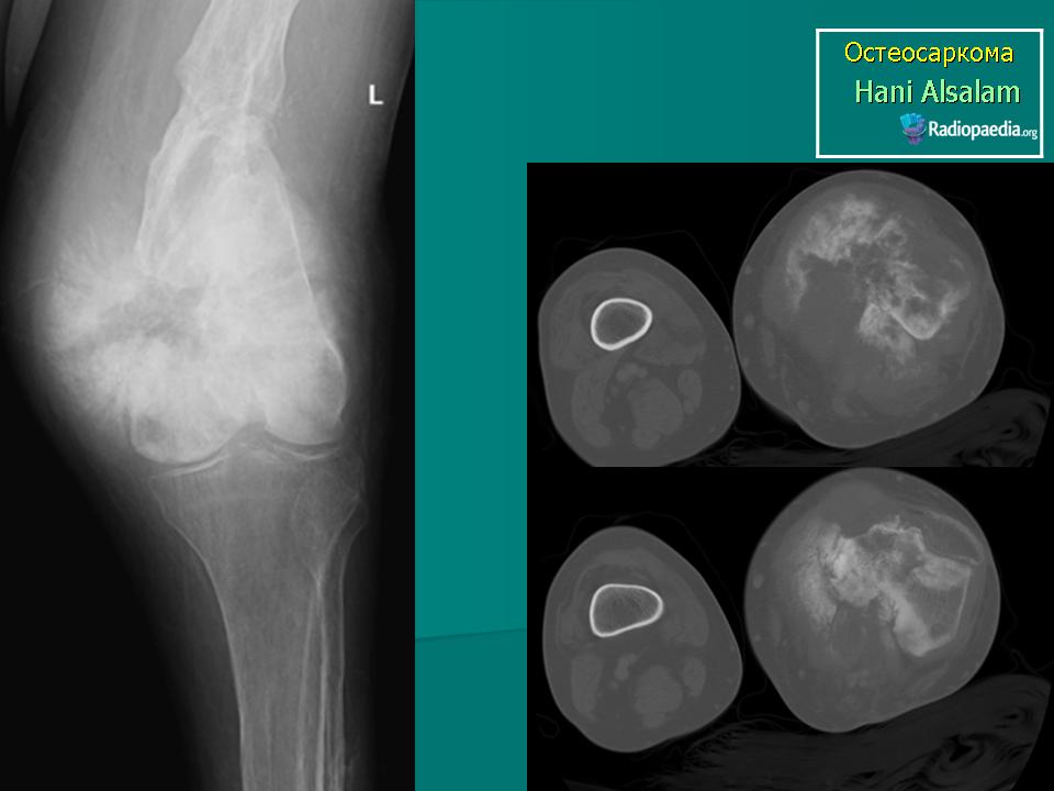 Остеосаркома симптомы фото