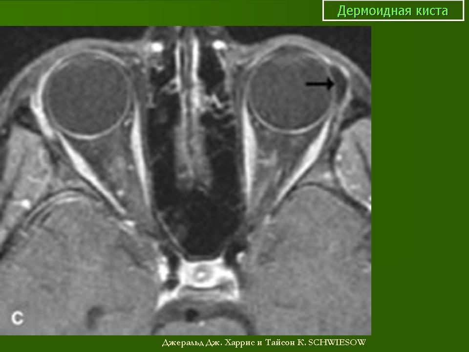 Киста в мм. Тератодермоидная киста. Дермоидная киста лобной кости. Дермоидная киста орбиты мрт.