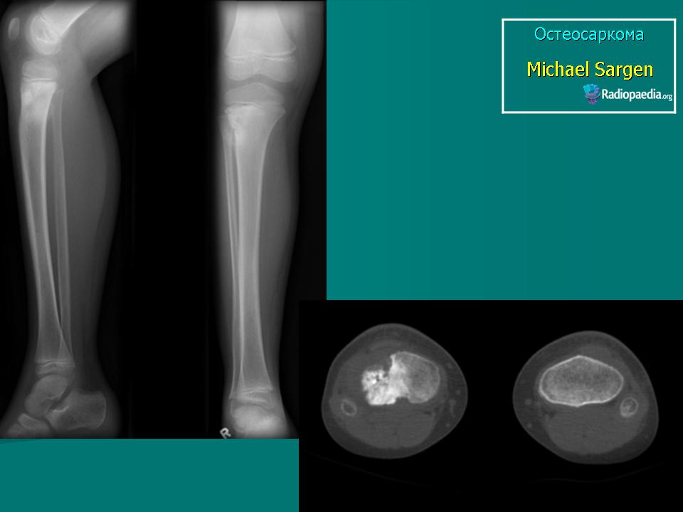 Остеосаркома. Параостальная остеогенная саркома. Остеогенная саркома костей череп.