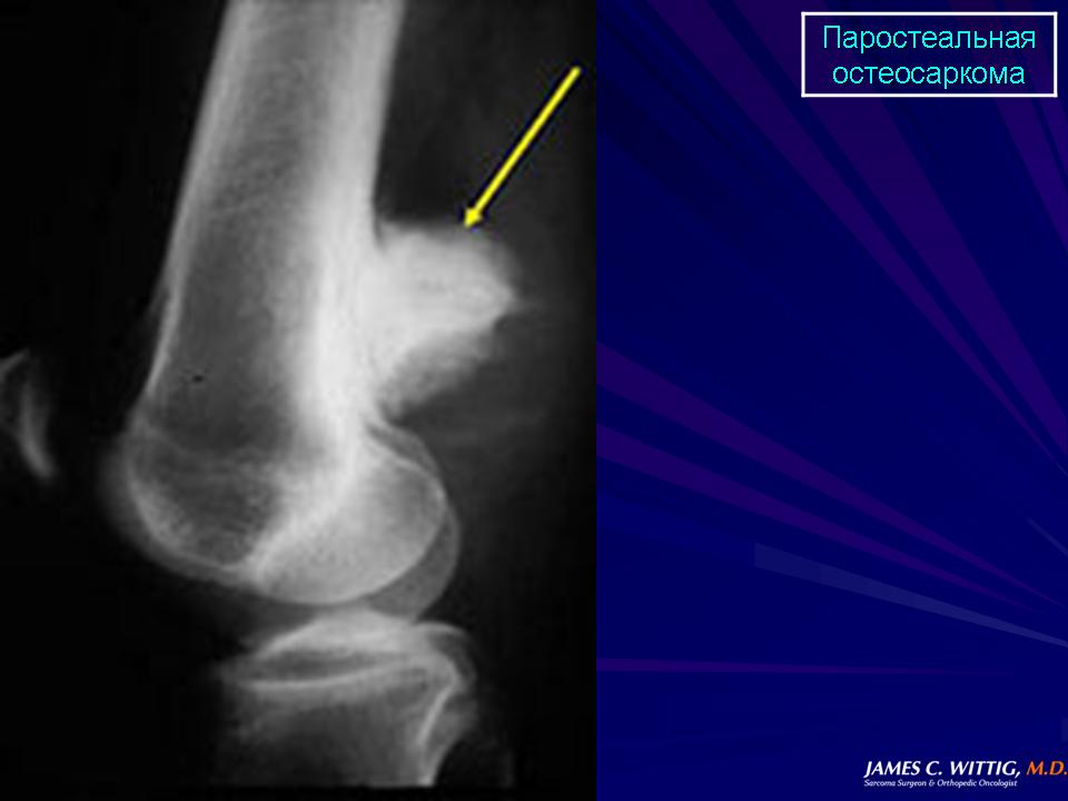 Саркомы костей нмо. Остеогенная саркома бедренной кости рентген. Саркома коленного сустава рентген. Остеосаркома коленного сустава кт.