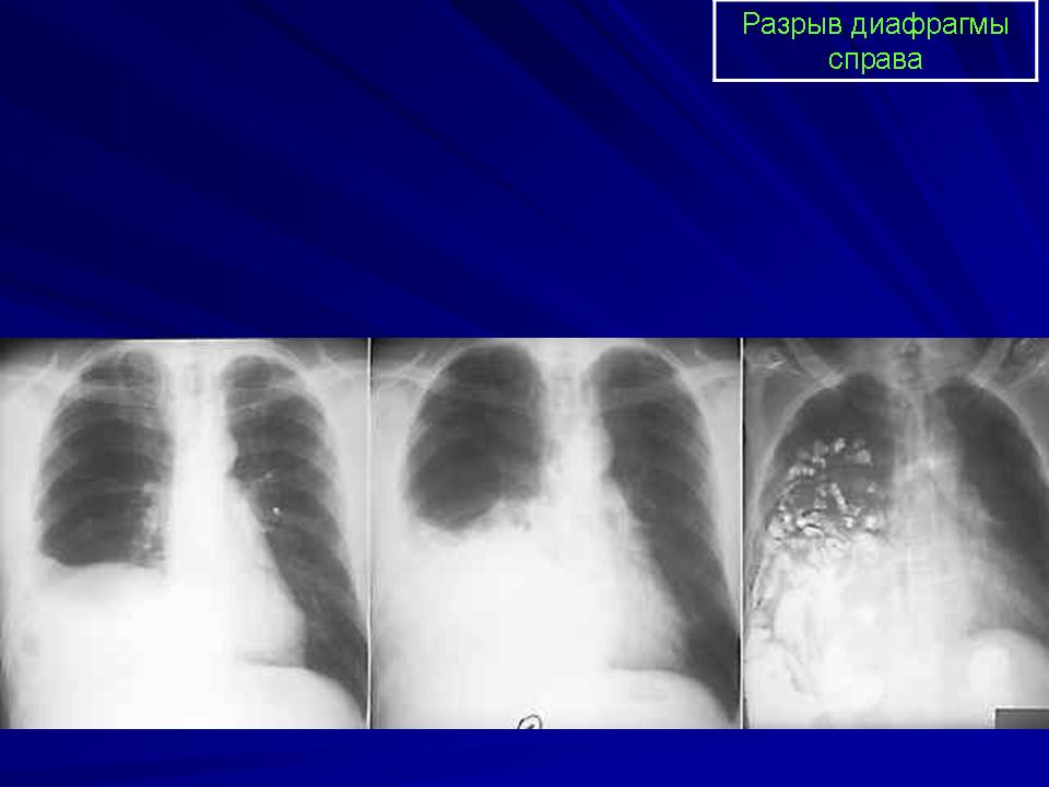 Симптом диафрагмы. Разрыв диафрагмы рентген. Травматические повреждения диафрагмы. Травматический разрыв диафрагмы симптомы. Травматическая грыжа диафрагмы рентген.