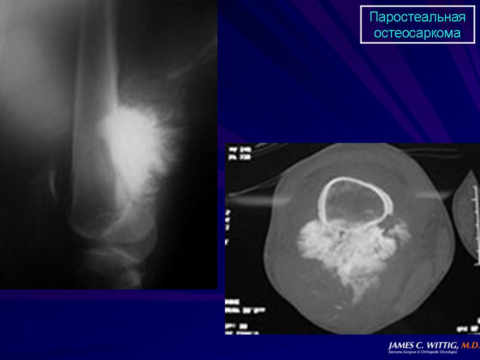 Остеосаркома симптомы фото