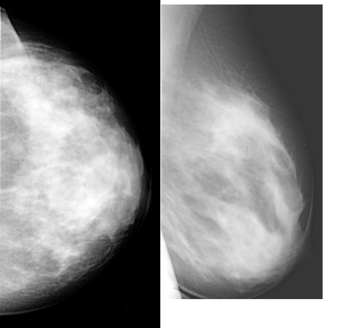 Маммография фкм. Мастопатия молочной железы маммограмма. Маммография микрокальцинаты.