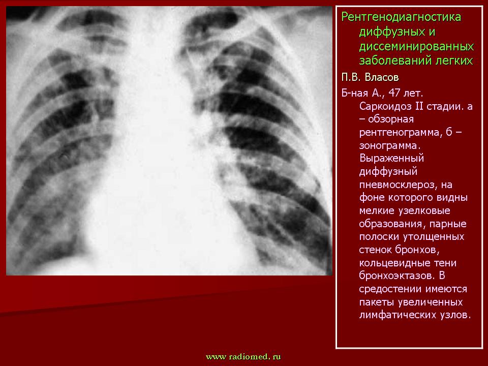 Легочный рисунок с признаками пневмосклероза что это значит у женщин
