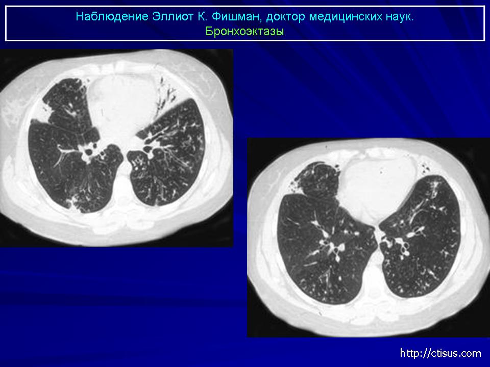 Кт бронхов