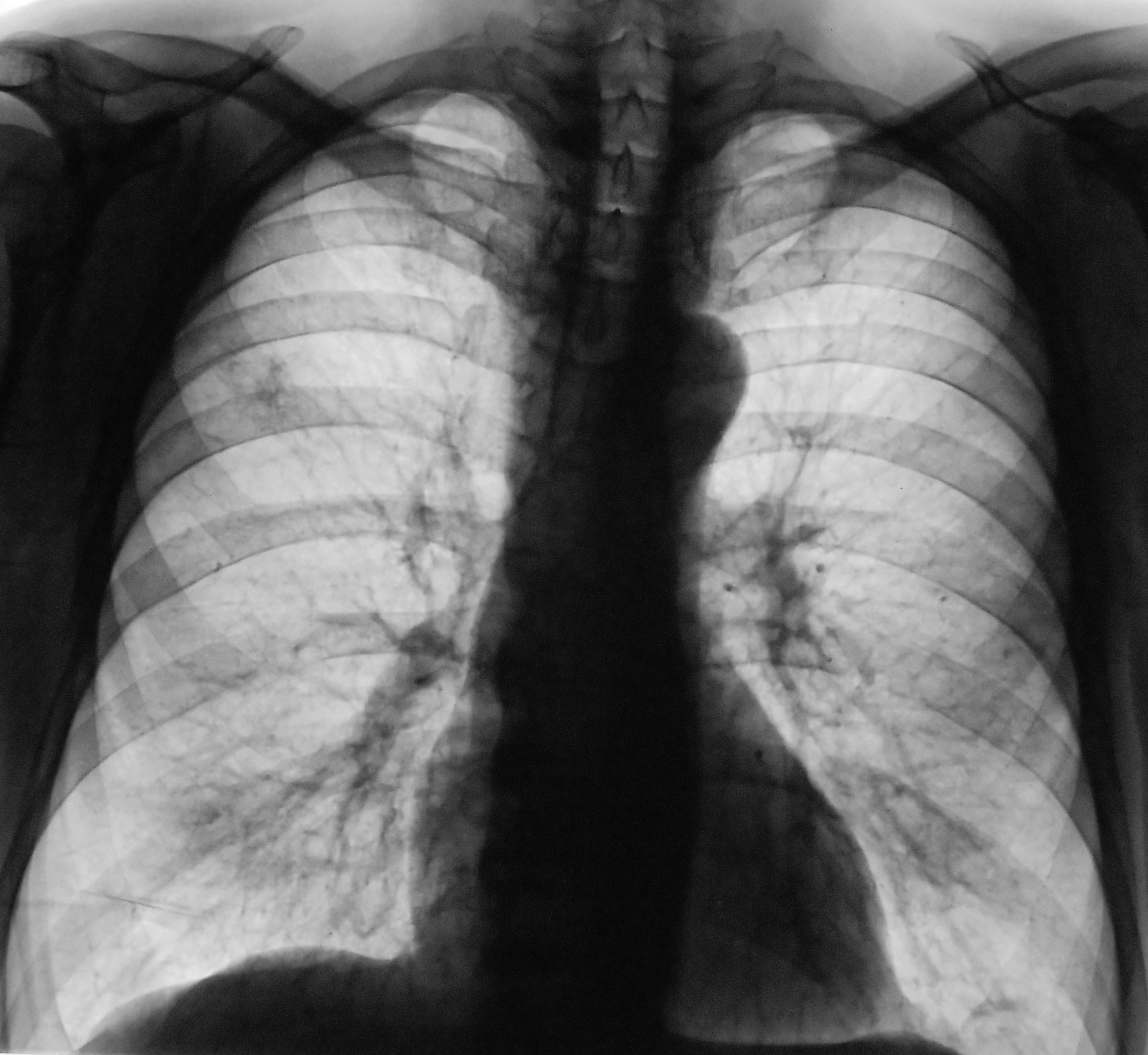 Флюорография снимок здоровых легких и больных фото