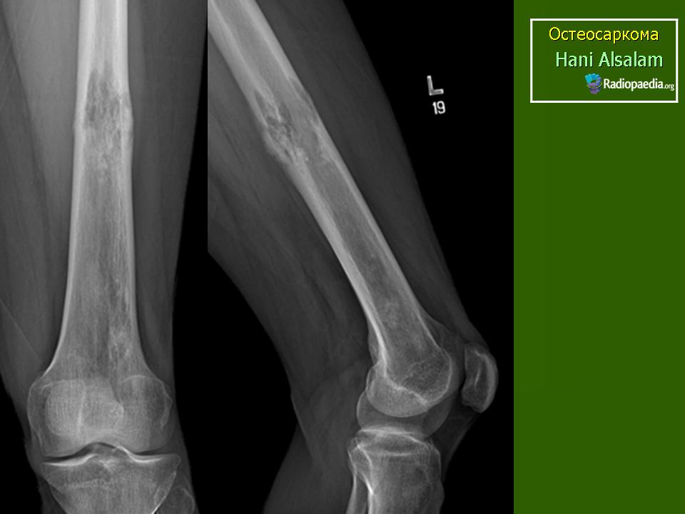 Саркома кости. Саркома кости Юинга большеберцовой кости симптомы. Остеосаркома кости голени. Саркома Юинга большеберцовой кости рентген.