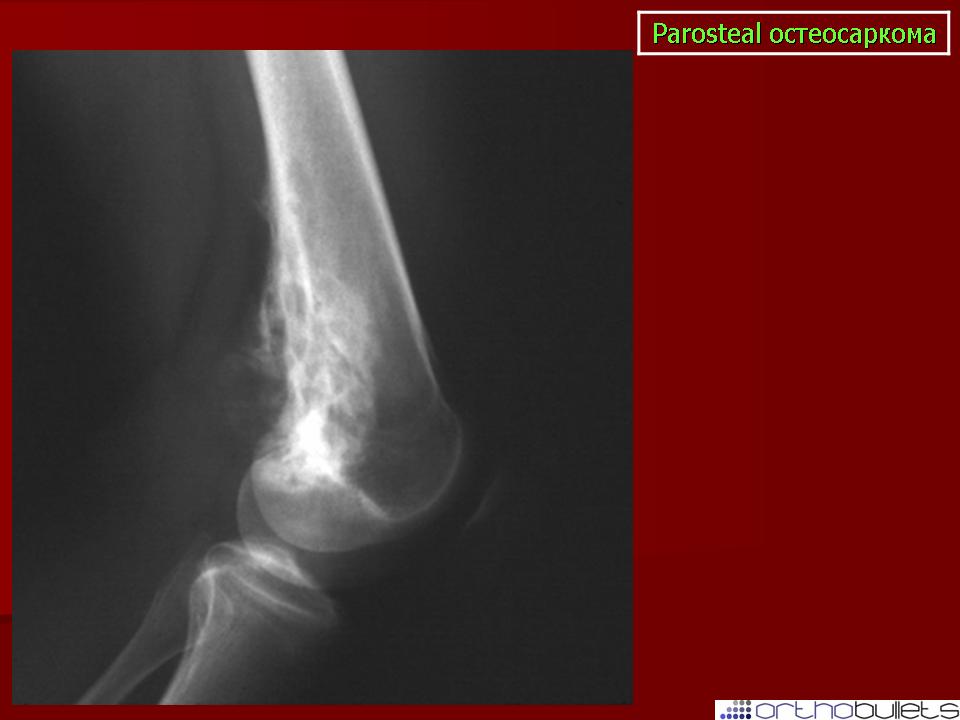 Остеосаркома. Параоссальная (юкстакортикальная) остеогенная саркома. Паростальная (юкстакортикальная) остеосаркома. Параоссальная (юкстакортикальная) остеосаркома. Паростальная саркома рентген.
