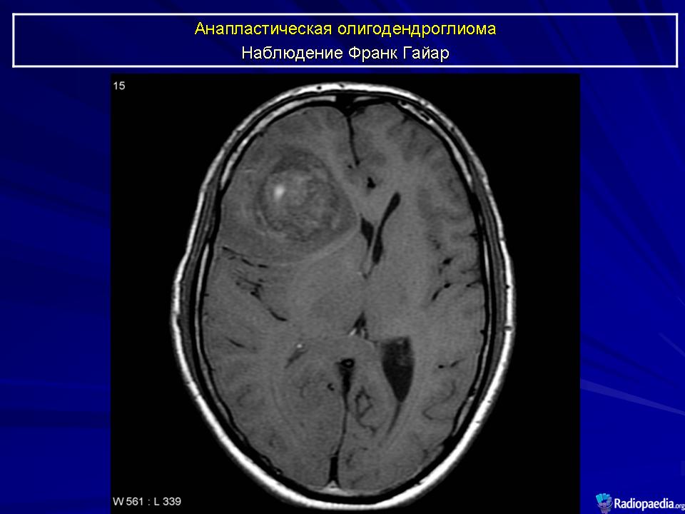 После операции менингиомы головного мозга. Анапластическая менингиома g3. Анапластическая (злокачественная) менингиома. Менингиома грейд. Олигодендроглиома мрт.