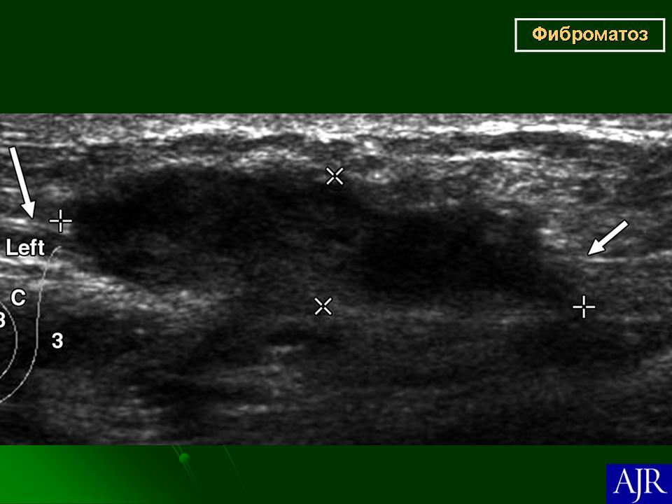 Фиброз молочных желез узи. Фиброаденома молочной железы УЗИ картина. Филлоидная фиброаденома молочной железы УЗИ. Листовидная фиброаденома молочной железы на УЗИ. Фиброаденома железы на УЗИ.