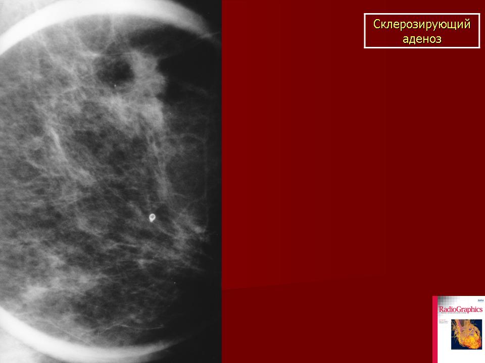 Аденоз на маммографии. Склерозирующий аденоз молочной рентген. Склерозирующий аденоз молочных желез на маммографии. Аденоз молочной железы гистология.