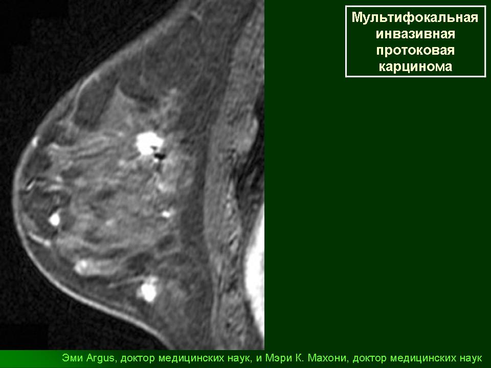 Очаговое образование фиброаденома