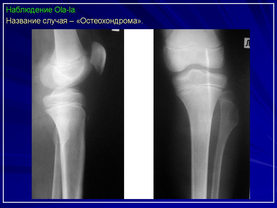 Экзостоз что. Костный экзостоз бедренной кости. Экзостоз большеберцовой кости рентген. Костно хрящевой экзостоз бедренной кости на кт. Экзостоз бедренной кости на рентгене.