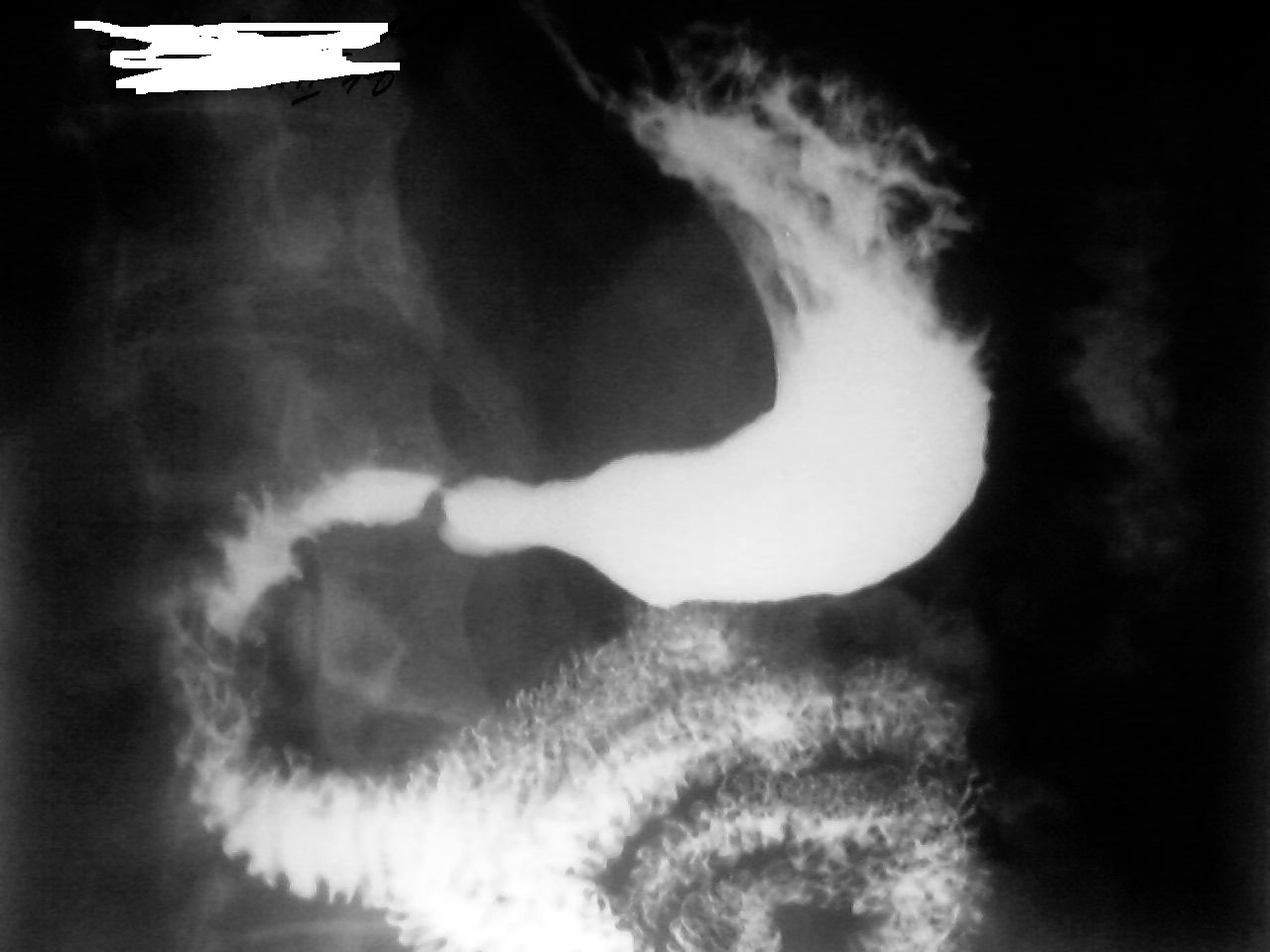 Скопия пищевода. Рентген пищеварительного тракта. Стеноз двенадцатиперстной кишки рентген. Скопия желудка рентген.