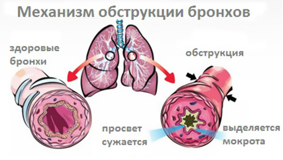 обструкция легких