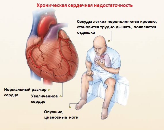 Сердечная недостаточность у человека симптомы