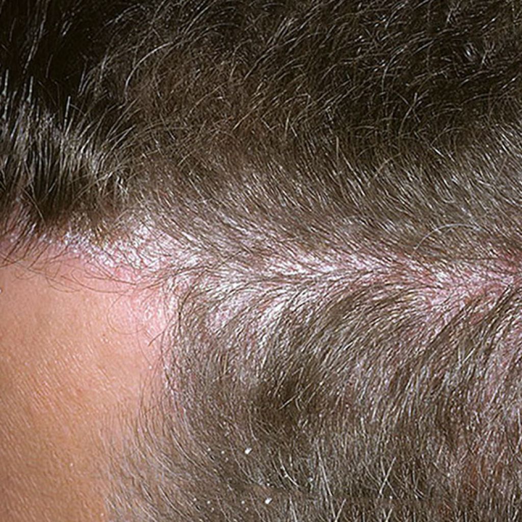 Экзема волосистой части головы фото