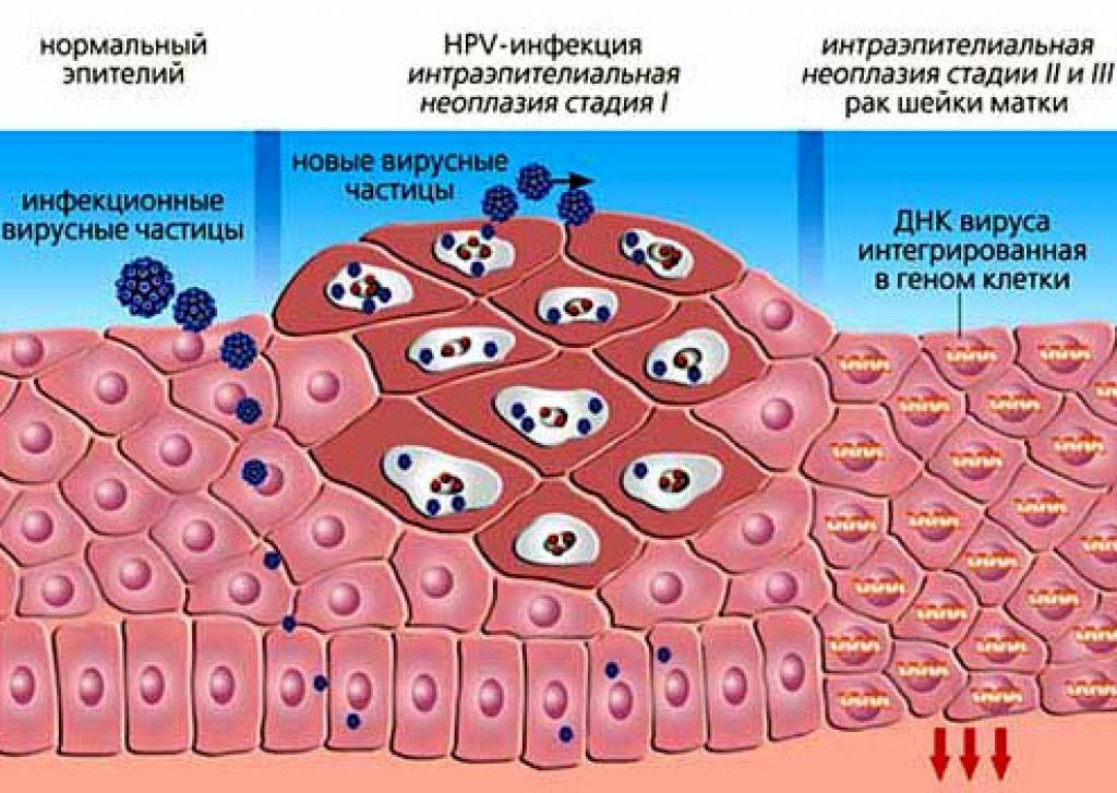 Человека папилломы человека рисунок