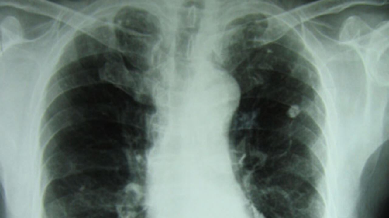 Туберкулез легкого рентгенограмма. Рентгенография туберкулеза. Туберкулез легких рентген.