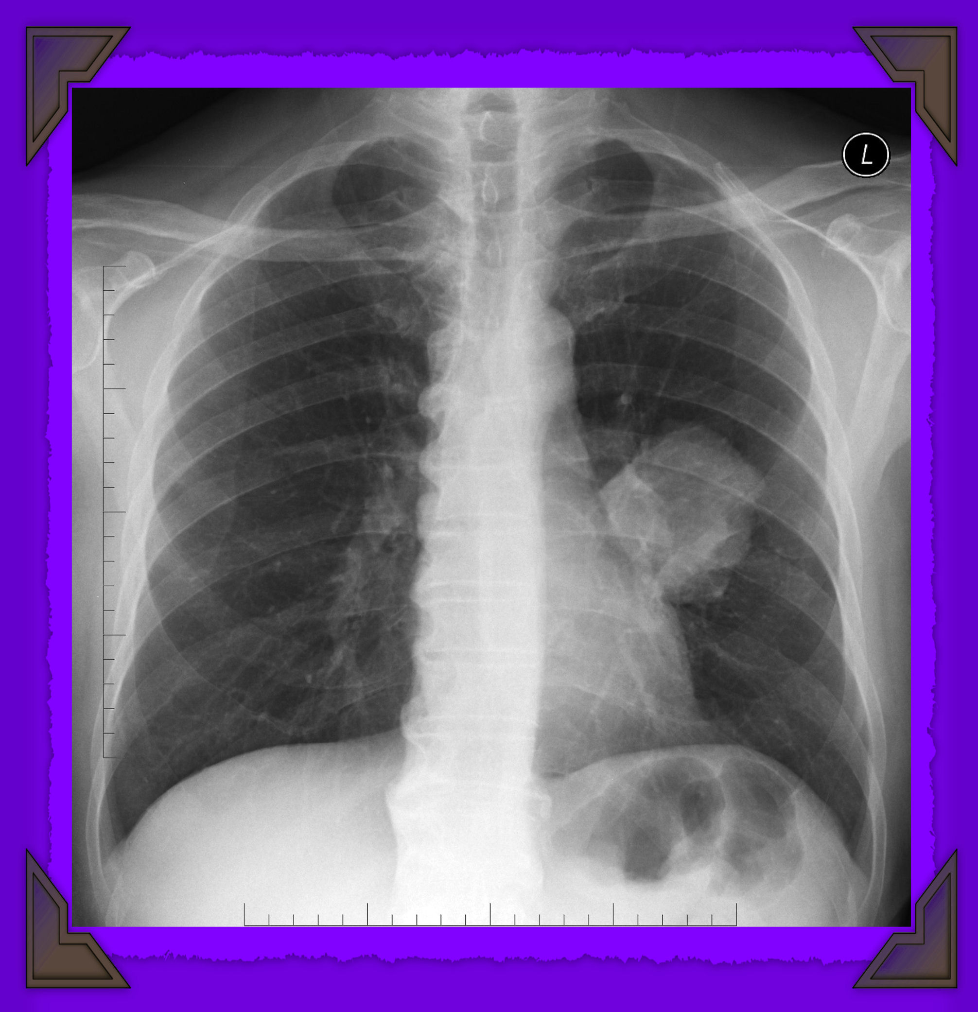Рак центрального правого. Туберкулез бронхов рентгенограмма. Опухоль легкого на рентгене. ФЛГ легких.