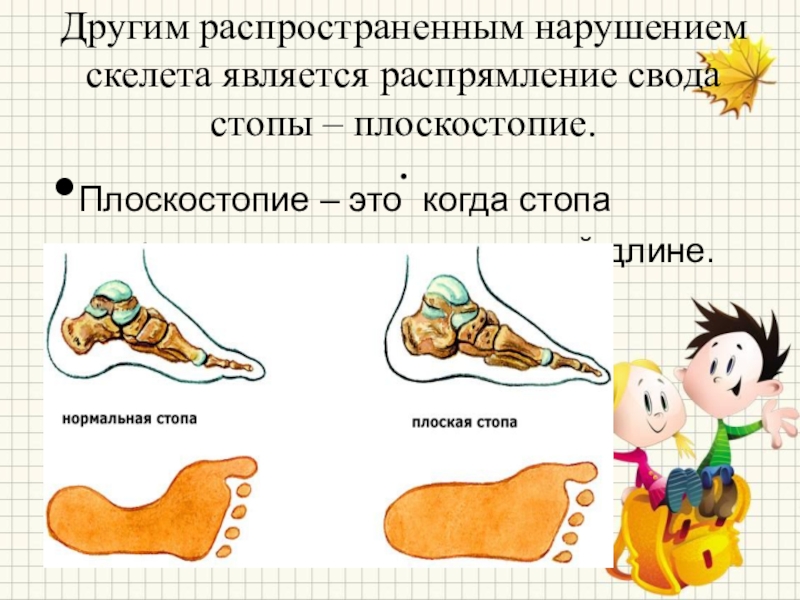 Плоскостопие позвоночник. Коньки для плоскостопия. Презентация по биологии по плоскостопию.