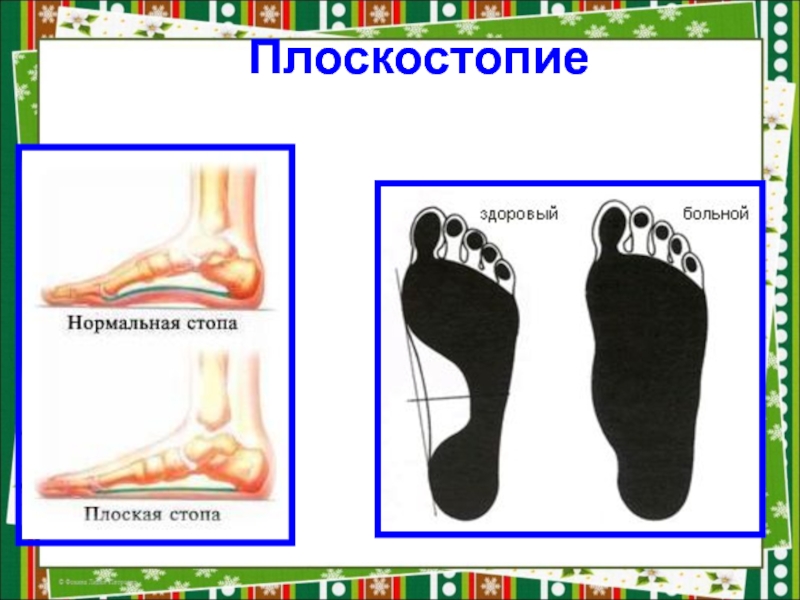 Как определить плоскостопие