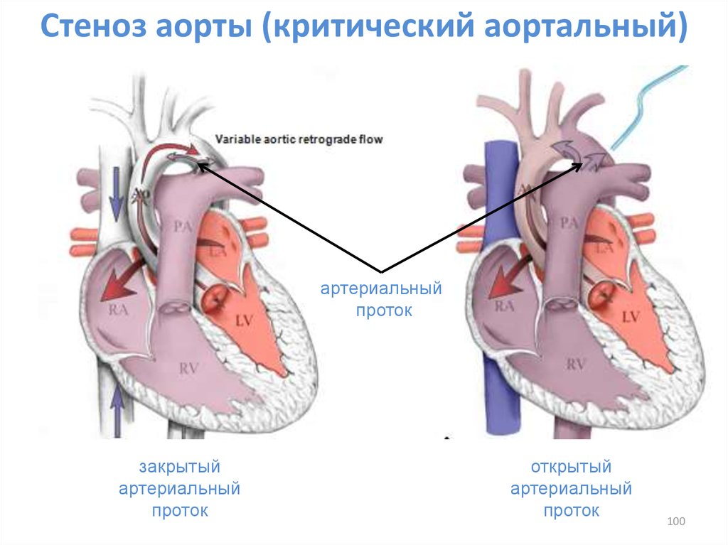 Аортальный стеноз что это такое. Стеноз устья аорты у детей. Аортальный стеноз УЗИ классификация. Врожденные пороки сердца аортальный стеноз. Изолированный аортальный стеноз врожденный.