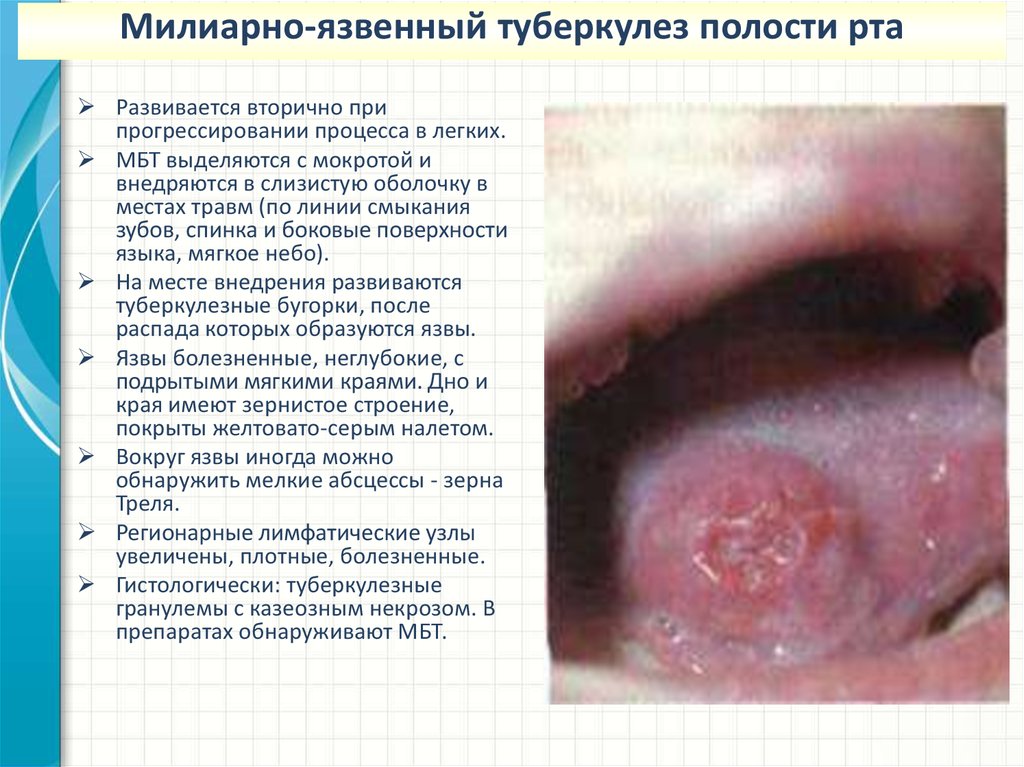 Туберкулез ротовой полости