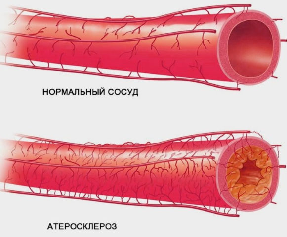 Атеросклероз